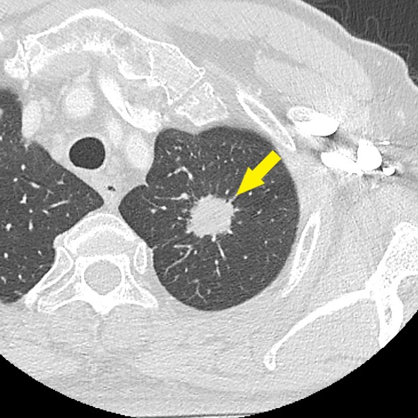 肺がんのCT画像